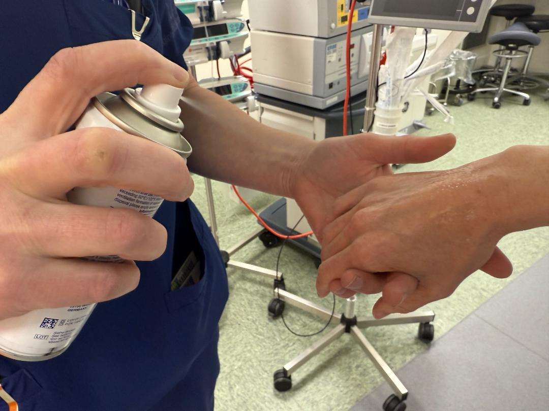 Sygehus sønderjylland cryospray Sygehus sønderjylland cryospray