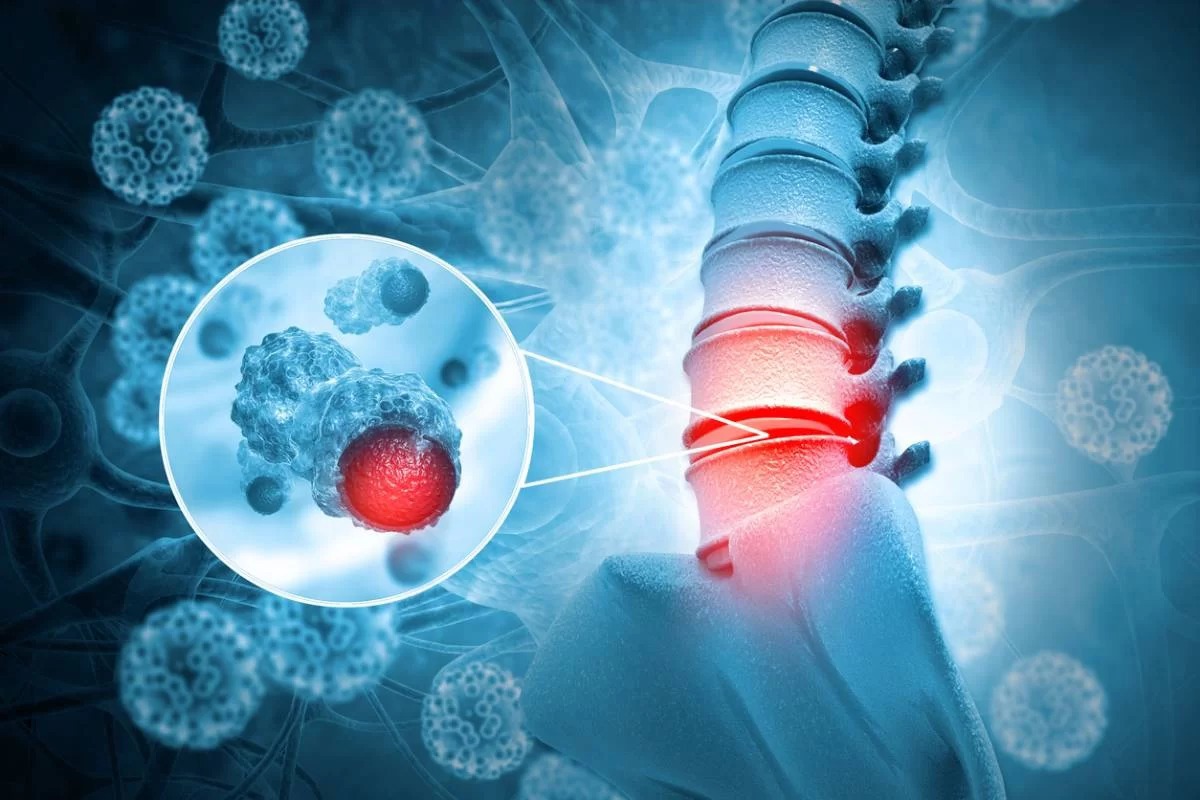 Spondylodiskitis