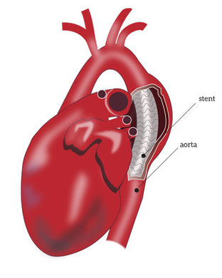 Stent-low