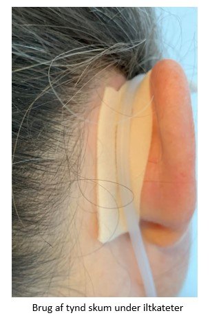 Foto 3. og 4. Tilpasset bandage påsat huden til forebyggelse af tryksår efter medicinsk udstyr
