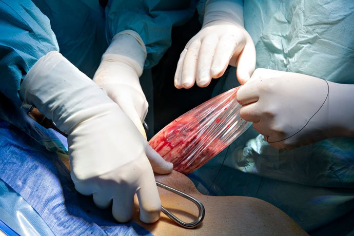 Nyren og urinlederen er opereret fri og er inde i patientens krop blevet puttet ned i en pose, så den
            nemt kan trækkes ud af et lidt større hul i maven.